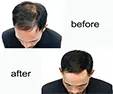 Hairline - Microblading Hairline - Microblading